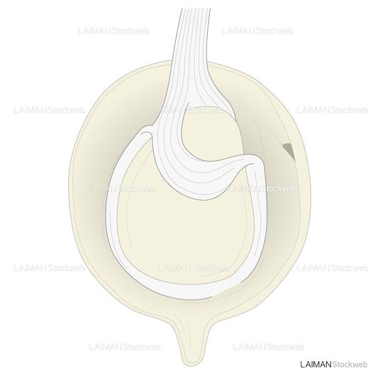 SLAP lesionに対するSnyder分類 TypeⅣ