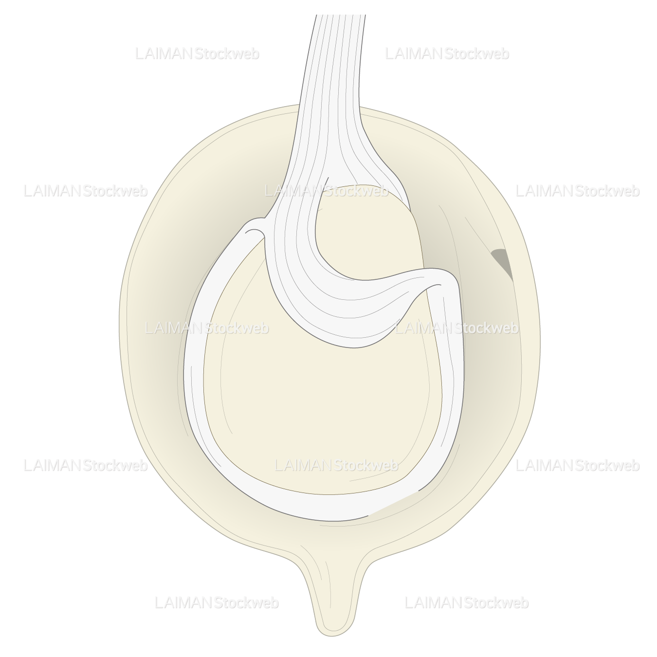 SLAP lesionに対するSnyder分類 TypeⅣ