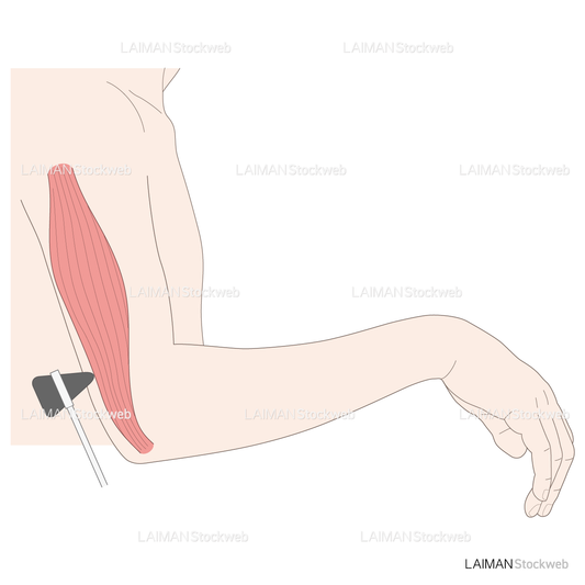 神経根障害高位診断（上腕三頭筋）